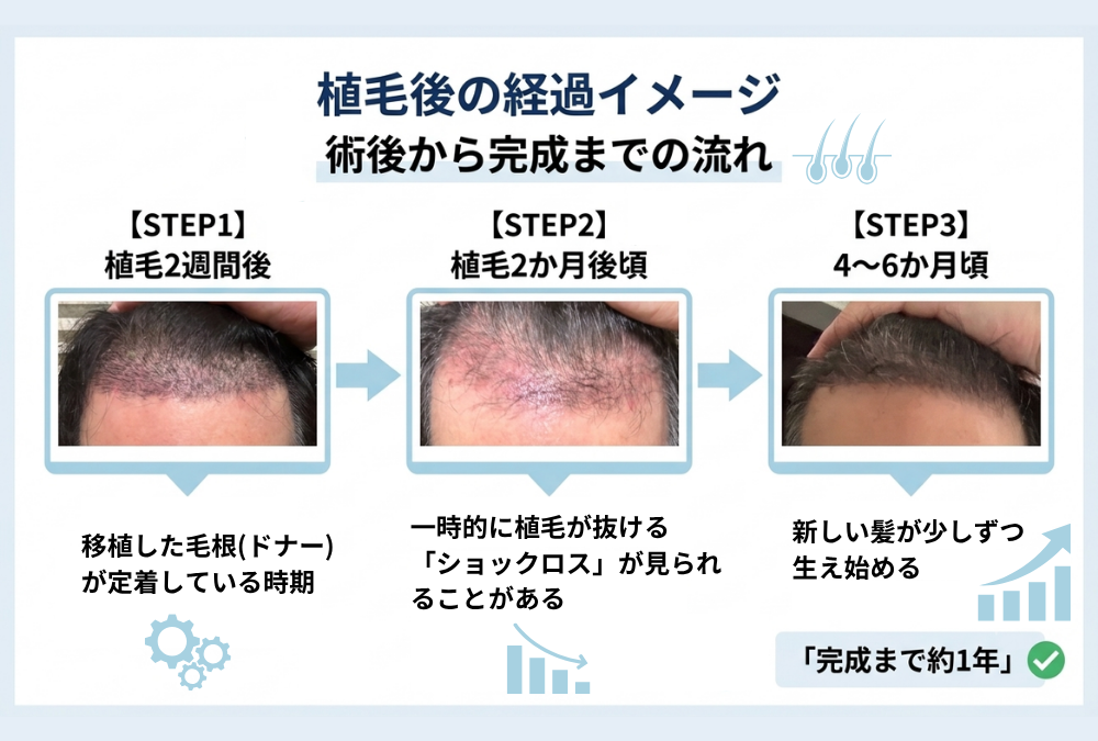 植毛後の経過タイムライン ショックロスの時期の目安
